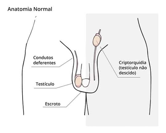 ilustração de criptorquidia site Dr. Rafael Rocha cirurgião pediatra e urologista infantil