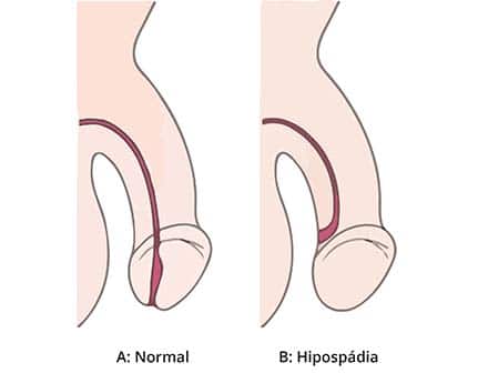 ilustração de pênis de criança com hipospádia site Dr. Rafael Rocha cirurgião pediatra e urologista infantil