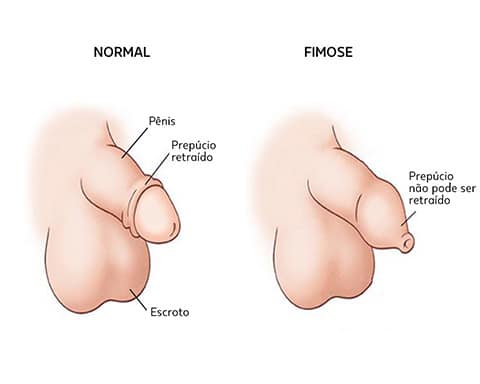 ilustração de pênis de criança com fimose site Dr. Rafael Rocha cirurgião pediatra e urologista infantil
