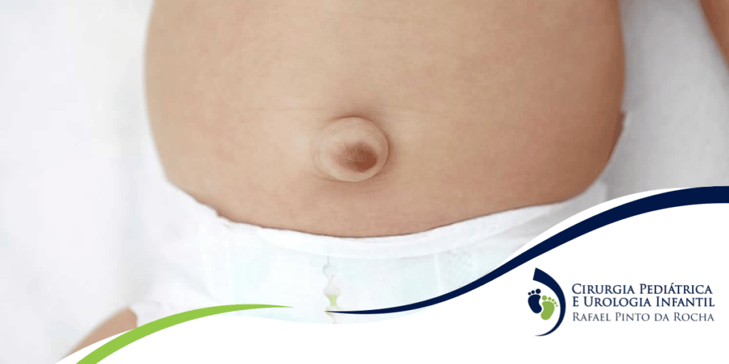 Barriga de criança com hérnia umbilical Dr. Rafael Rocha cirurgião pediátrico de SP