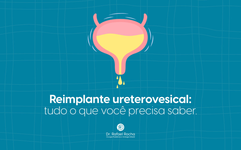Reimplante ureterovesical: tudo o que você precisa saber.