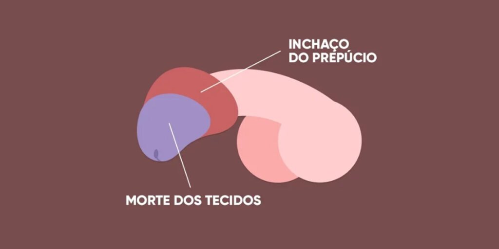 Ilustração mostrando parafimose site Dr. Rafael Rocha cirurgião pediátrico e urologista infantil
